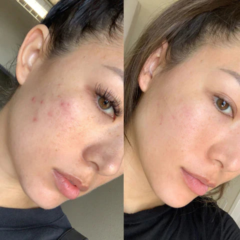 Auralane FaceLift Pro | Neck Face Firming Wrinkle Removal