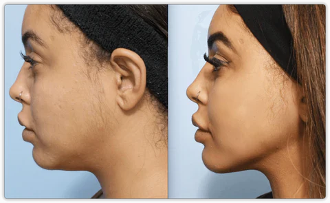 Auralane FaceLift Pro | Neck Face Firming Wrinkle Removal