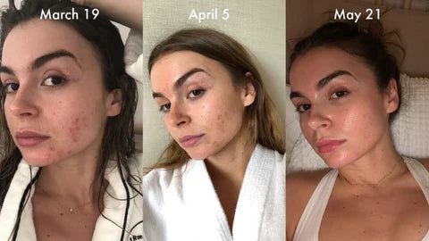 Auralane FaceLift Pro | Neck Face Firming Wrinkle Removal