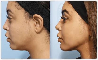 Auralane FaceLift Pro | Neck Face Firming Wrinkle Removal